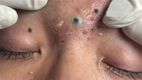 masive facial|Big Cystic Acne Blackheads Extraction Blackheads & Milia.